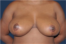 Breast Reduction After Photo by Jerry Weiger Chang, MD, FACS; Flushing, NY - Case 43264
