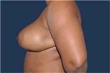 Breast Reduction After Photo by Jerry Weiger Chang, MD, FACS; Flushing, NY - Case 43264