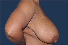 Breast Reduction Before Photo by Jerry Weiger Chang, MD, FACS; Flushing, NY - Case 43264