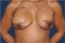 Breast Reconstruction After Photo by Jerry Weiger Chang, MD, FACS; Flushing, NY - Case 43265