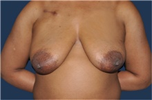 Breast Reconstruction Before Photo by Jerry Weiger Chang, MD, FACS; Flushing, NY - Case 43265