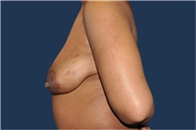 Breast Reconstruction Before Photo by Jerry Weiger Chang, MD, FACS; Flushing, NY - Case 43265