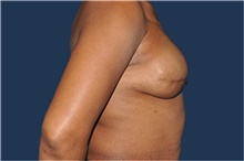 Breast Reconstruction After Photo by Jerry Weiger Chang, MD, FACS; Flushing, NY - Case 43265