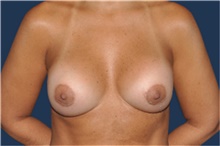 Breast Augmentation After Photo by Jerry Weiger Chang, MD, FACS; Flushing, NY - Case 43266