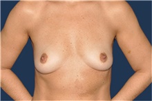 Breast Augmentation Before Photo by Jerry Weiger Chang, MD, FACS; Flushing, NY - Case 43266