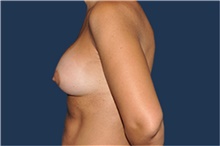 Breast Augmentation After Photo by Jerry Weiger Chang, MD, FACS; Flushing, NY - Case 43266