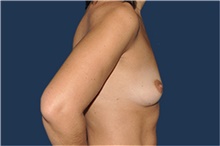 Breast Augmentation Before Photo by Jerry Weiger Chang, MD, FACS; Flushing, NY - Case 43266