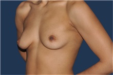 Breast Reconstruction Before Photo by Jerry Weiger Chang, MD, FACS; Flushing, NY - Case 43267