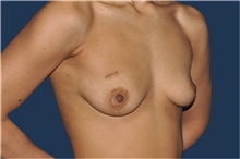 Breast Reconstruction Before Photo by Jerry Weiger Chang, MD, FACS; Flushing, NY - Case 43267