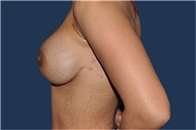 Breast Reconstruction After Photo by Jerry Weiger Chang, MD, FACS; Flushing, NY - Case 43267