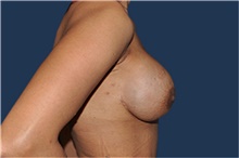 Breast Reconstruction After Photo by Jerry Weiger Chang, MD, FACS; Flushing, NY - Case 43267