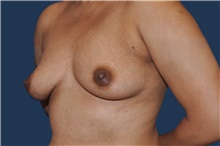 Breast Reconstruction Before Photo by Jerry Weiger Chang, MD, FACS; Flushing, NY - Case 44874