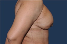 Breast Reconstruction After Photo by Jerry Weiger Chang, MD, FACS; Flushing, NY - Case 44874