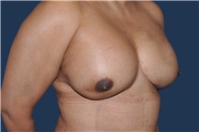 Breast Reconstruction After Photo by Jerry Weiger Chang, MD, FACS; Flushing, NY - Case 44874