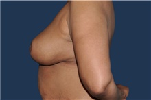 Breast Reduction After Photo by Jerry Weiger Chang, MD, FACS; Flushing, NY - Case 44875