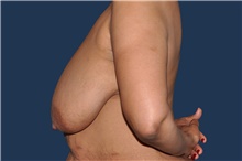 Breast Reduction Before Photo by Jerry Weiger Chang, MD, FACS; Flushing, NY - Case 44875