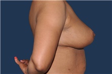 Breast Reduction After Photo by Jerry Weiger Chang, MD, FACS; Flushing, NY - Case 44875