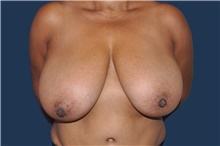 Breast Reduction Before Photo by Jerry Weiger Chang, MD, FACS; Flushing, NY - Case 44876