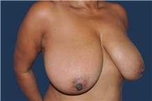 Breast Reduction Before Photo by Jerry Weiger Chang, MD, FACS; Flushing, NY - Case 44876