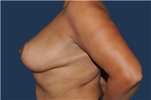 Breast Reduction After Photo by Jerry Weiger Chang, MD, FACS; Flushing, NY - Case 44876