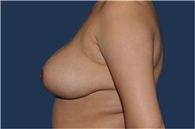 Breast Reduction After Photo by Jerry Weiger Chang, MD, FACS; Flushing, NY - Case 44878