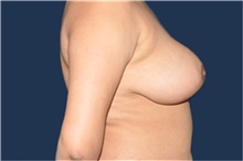 Breast Reduction After Photo by Jerry Weiger Chang, MD, FACS; Flushing, NY - Case 44878