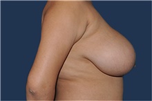 Breast Reduction Before Photo by Jerry Weiger Chang, MD, FACS; Flushing, NY - Case 44878