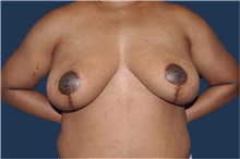 Breast Reduction After Photo by Jerry Weiger Chang, MD, FACS; Flushing, NY - Case 44879