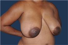 Breast Reduction Before Photo by Jerry Weiger Chang, MD, FACS; Flushing, NY - Case 44879
