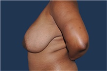 Breast Reduction Before Photo by Jerry Weiger Chang, MD, FACS; Flushing, NY - Case 44879
