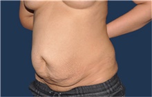 Tummy Tuck Before Photo by Jerry Weiger Chang, MD, FACS; Flushing, NY - Case 44880