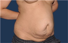Tummy Tuck Before Photo by Jerry Weiger Chang, MD, FACS; Flushing, NY - Case 44880