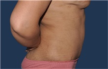 Tummy Tuck After Photo by Jerry Weiger Chang, MD, FACS; Flushing, NY - Case 44880