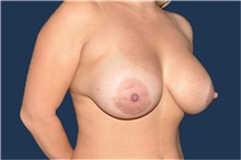 Breast Augmentation After Photo by Jerry Weiger Chang, MD, FACS; Flushing, NY - Case 44881