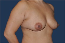Breast Augmentation Before Photo by Jerry Weiger Chang, MD, FACS; Flushing, NY - Case 44881