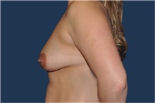 Breast Augmentation Before Photo by Jerry Weiger Chang, MD, FACS; Flushing, NY - Case 44881