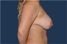 Breast Augmentation After Photo by Jerry Weiger Chang, MD, FACS; Flushing, NY - Case 44881
