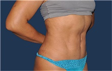 Tummy Tuck After Photo by Jerry Weiger Chang, MD, FACS; Flushing, NY - Case 44883