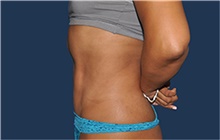 Tummy Tuck After Photo by Jerry Weiger Chang, MD, FACS; Flushing, NY - Case 44883