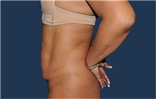 Tummy Tuck Before Photo by Jerry Weiger Chang, MD, FACS; Flushing, NY - Case 44883