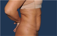 Tummy Tuck Before Photo by Jerry Weiger Chang, MD, FACS; Flushing, NY - Case 44883