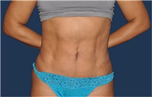Liposuction After Photo by Jerry Weiger Chang, MD, FACS; Flushing, NY - Case 44884