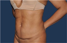 Liposuction Before Photo by Jerry Weiger Chang, MD, FACS; Flushing, NY - Case 44884
