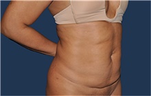 Liposuction Before Photo by Jerry Weiger Chang, MD, FACS; Flushing, NY - Case 44884