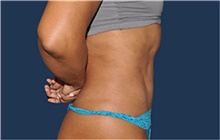 Liposuction After Photo by Jerry Weiger Chang, MD, FACS; Flushing, NY - Case 44884
