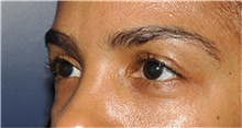 Eyelid Surgery Before Photo by Jerry Weiger Chang, MD, FACS; Flushing, NY - Case 44885