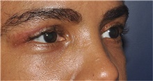 Eyelid Surgery After Photo by Jerry Weiger Chang, MD, FACS; Flushing, NY - Case 44885