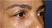 Eyelid Surgery Before Photo by Jerry Weiger Chang, MD, FACS; Flushing, NY - Case 44885