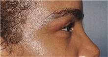 Eyelid Surgery After Photo by Jerry Weiger Chang, MD, FACS; Flushing, NY - Case 44885