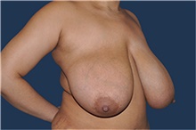Breast Reduction Before Photo by Jerry Weiger Chang, MD, FACS; Flushing, NY - Case 44886